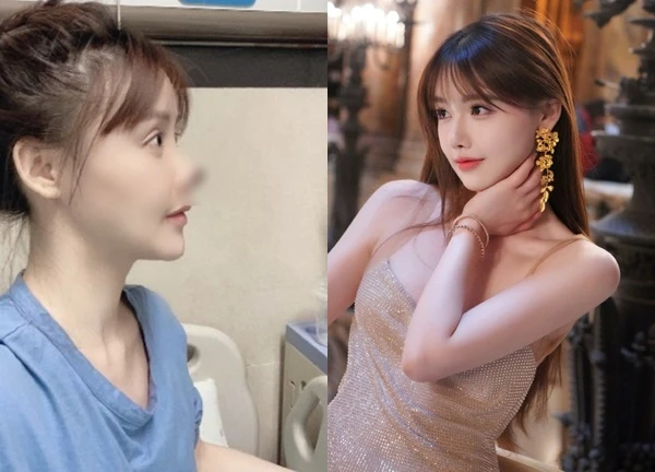 Mỹ nhân 9X bị hoại tử, rụng chóp mũi vì gặp biến chứng thẩm mỹ kinh hoàng nhất showbiz giờ ra sao?