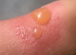 Trị phồng rộp da do cháy nắng