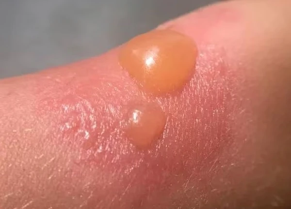 Trị phồng rộp da do cháy nắng