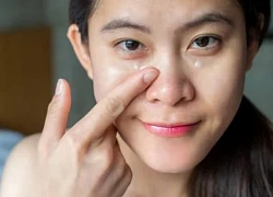 6 cách giảm bọng mắt, quầng thâm cho dân văn phòng không cần can thiệp xâm lấn