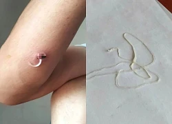 Cảnh báo: Nhiễm giun rồng nguy hiểm do ăn món "đặc sản" gỏi cá