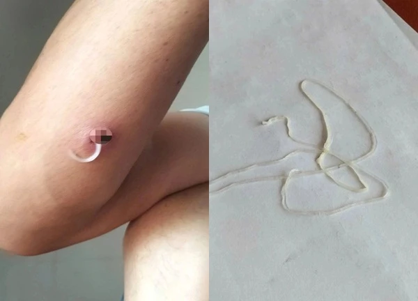 Cảnh báo: Nhiễm giun rồng nguy hiểm do ăn món "đặc sản" gỏi cá