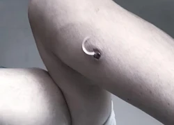 Giun rồng 'đục khoét' cơ thể người đàn ông