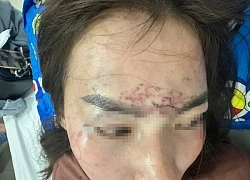 Khởi tố vụ người phụ nữ đi đường bất ngờ bị kéo lên ô tô, 'tra tấn' bằng axit