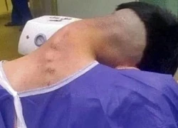 Nam thanh niên mắc "hội chứng đầu gục" do lạm dụng chất gây nghiện