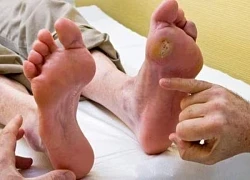 Nắng nóng, 3 việc người bệnh tiểu đường nên làm để ổn định đường huyết, phòng ngừa biến chứng
