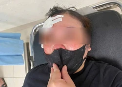 Nữ tài xế ở Hà Nội 'tố' bị người đi ô tô dùng dùi cui vụt vào đầu