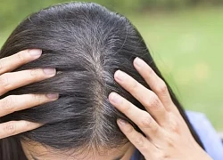 Tóc khô và xỉn màu là dấu hiệu của những bệnh này