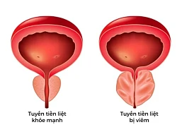 4 loại viêm tuyến tiền liệt phổ biến ở nam giới
