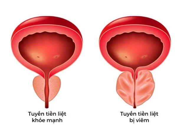 4 loại viêm tuyến tiền liệt phổ biến ở nam giới