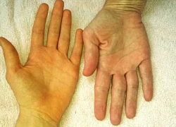 Dấu hiệu ung thư gan bạn không nên bỏ qua