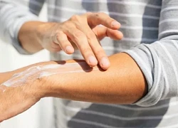 Đề phòng bệnh về da mùa nắng nóng
