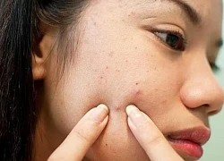 Giải pháp hạn chế tiết dầu cho da dầu vào mùa hè