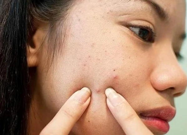 Giải pháp hạn chế tiết dầu cho da dầu vào mùa hè