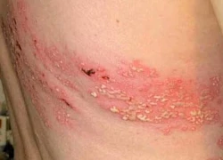 Mắc zona thần kinh có cần kiêng gì không?