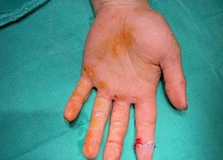 Nam công nhân bị cuốn vào máy cắt đứt lìa ngón tay do 1 lỗi nhiều người thường mắc phải