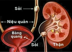 Sỏi tiết niệu hiểm họa thầm lặng có thể gây suy thận và tử vong