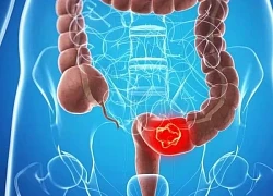8 dấu hiệu cảnh báo sớm ung thư đại trực tràng