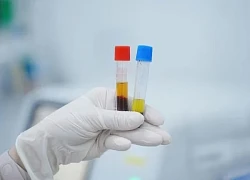 Nam thanh niên có huyết thanh đục trắng như sữa hiếm gặp