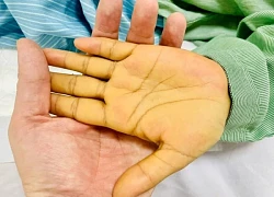 Bệnh nhân 43 tuổi có hàng tỷ virus viêm gan B trong máu