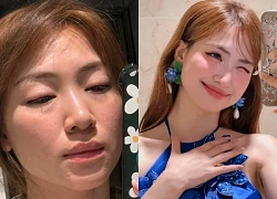Hoà Minzy lộ nhan sắc sưng phù gây sốc