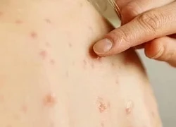 5 điều cần biết về bệnh thủy đậu