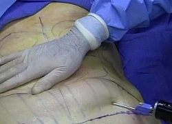 Bệnh nhân nhiễm trùng sau phẫu thuật hút mỡ tại TPHCM