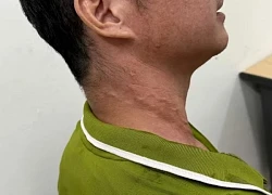 Ghi nhận bệnh nhân thứ 26 mắc giun rồng tại Việt Nam