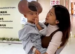 Nốt ruồi khổng lồ phủ kín hộp sọ khiến cậu bé có ngoại hình giống chuột Mickey