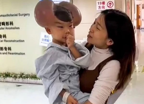 Nốt ruồi khổng lồ phủ kín hộp sọ khiến cậu bé có ngoại hình giống chuột Mickey