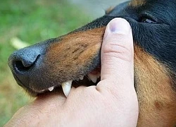 Uống thuốc nam sau khi bị chó cắn, bé trai 13 tuổi nguy kịch