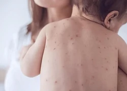 'Hậu sởi gây mất trí nhớ miễn dịch' là gì?