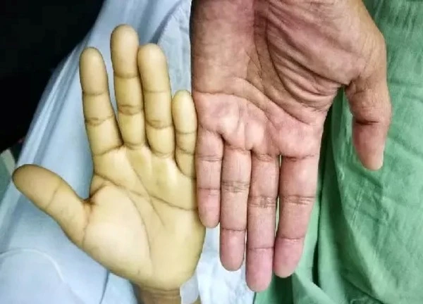 Hiểu lầm phổ biến về sữa của cha mẹ khiến bé 3 tuổi phải truyền máu