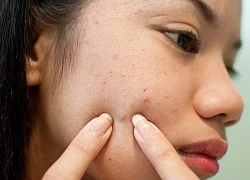 Thói quen sờ tay lên mặt gây hại gì cho làn da?