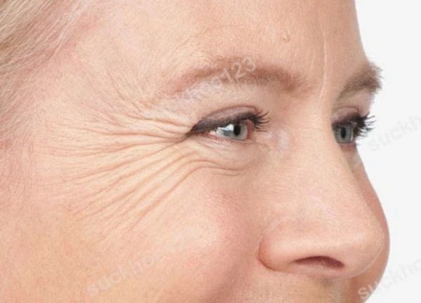 5 động tác đơn giản hằng ngày xóa mờ nếp nhăn đuôi mắt