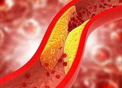 7 loại thực phẩm giúp giảm mỡ máu xấu (cholesterol xấu)