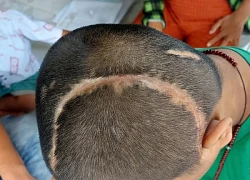 Cha cõng con trai bị tai nạn tổn thương cơ thể 90% đến tòa tìm công lý