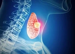 Đau họng kéo dài, bé trai 8 tuổi phát hiện ung thư tuyến giáp di căn