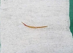 Liên tiếp các ca cấp cứu do thủng nội tạng vì xương cá