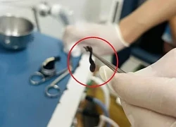 Thấy chảy máu mũi kéo dài, bé trai đến viện bác sĩ gắp ra thứ 'đáng sợ'
