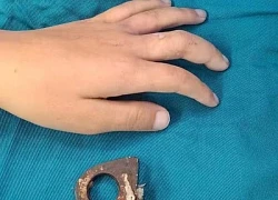 Vòng khóa siết ngón tay bé trai, gia đình cưa cửa mang đến viện