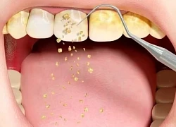 Tại sao phải lấy cao răng?