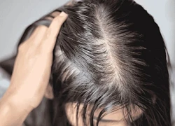 Các phương pháp điều trị rụng tóc tốt nhất cho phụ nữ