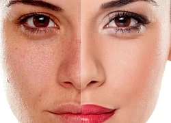 Cách khắc phục làn da bị cháy nắng