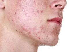 Cách trị mụn trứng cá hiệu quả nhất