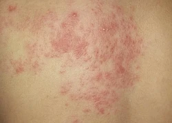Đã từng mắc thủy đậu có cần tiêm vaccine?