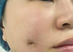 Người phụ nữ nhập viện sau khi làm đẹp tại spa