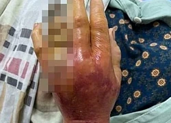 Nhiễm khuẩn, viêm hoại tử bàn tay sau khi bị gai cá đâ.m