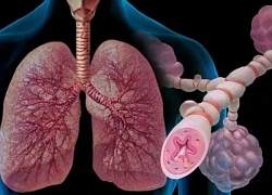 Những lưu ý quan trọng cho người bệnh hen phế quản