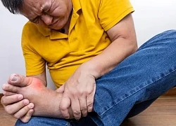 Phân biệt bệnh gout và viêm khớp dạng thấp